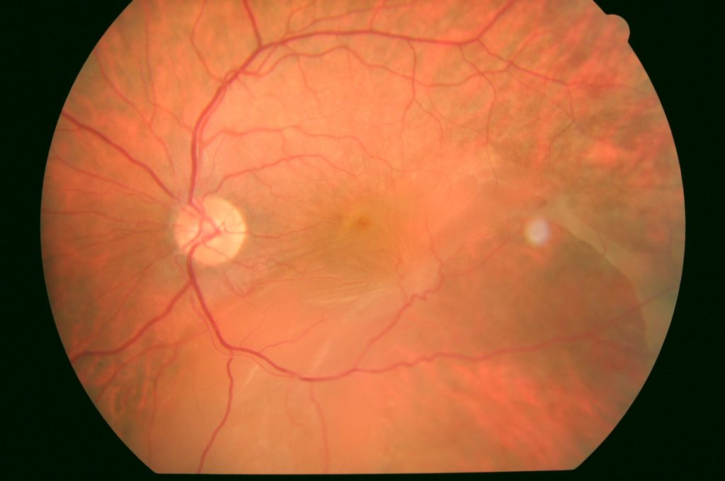 Imagen de un desprendimiento de retina (DR) de larga evolución, Clínica Oftalmológica Bajo-Castro, Oviedo, Asturias