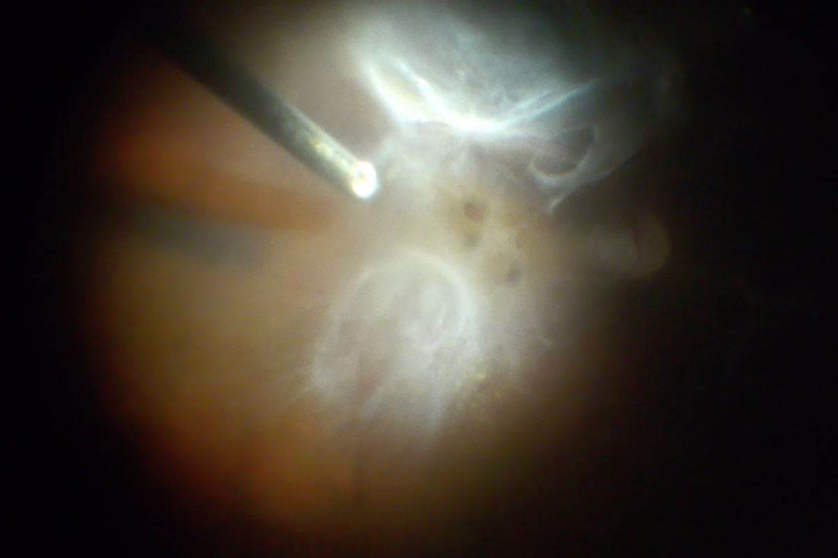 Foto de una Vitrectomia de retinopatia diabetica con DR y agujero macular en Clinica oftalmologica Bajo-Castro en Oviedo (Asturias)